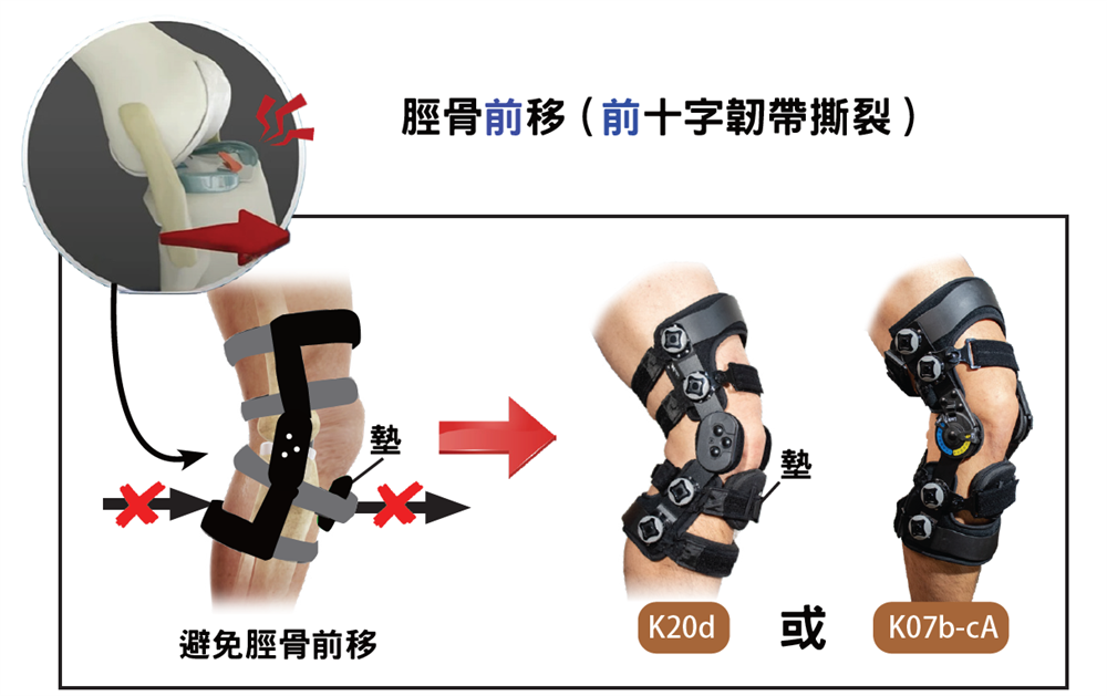 ACL Slippage Prevention Brace